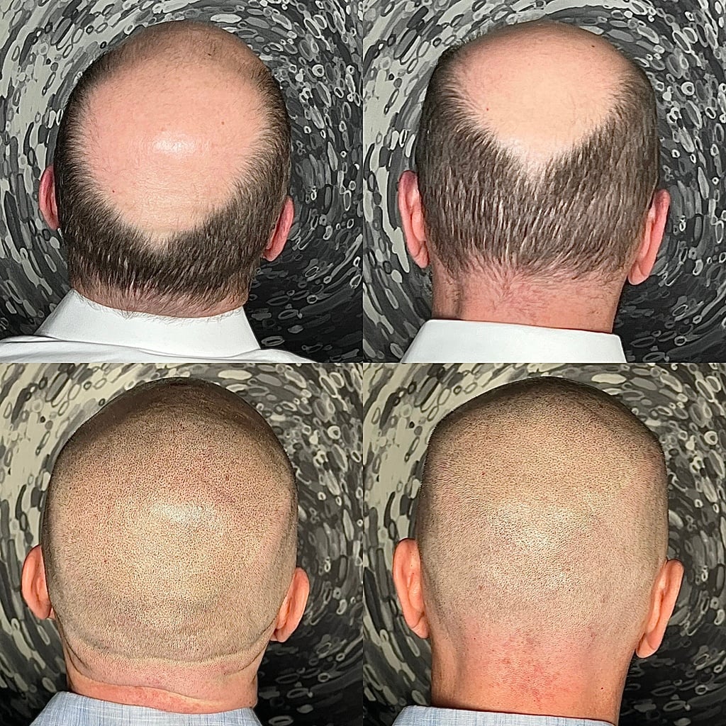 SCALP MICROPIGMENTATION