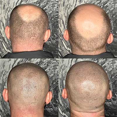 Scalp-Micropigmentation-Services