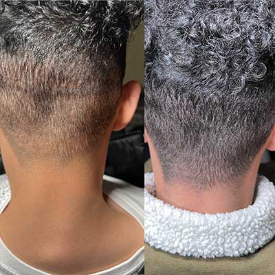 Scar-Micropigmentation-Services