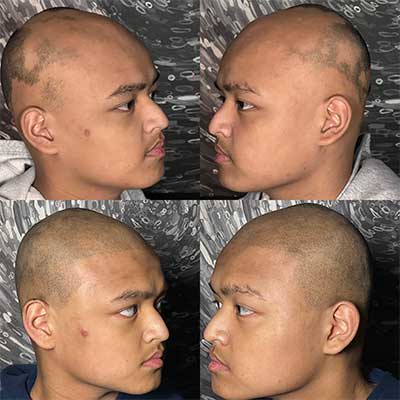 Scalp Micropigmentation for Alopecia Services