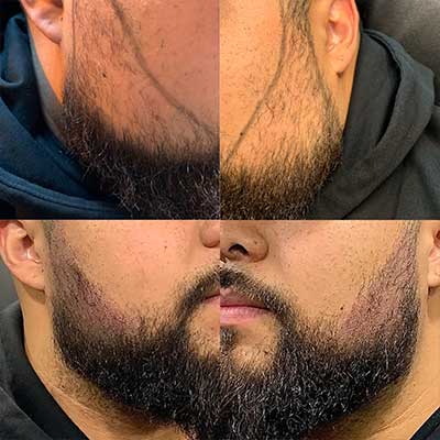 Facial Micropigmentation for Alopecia Services