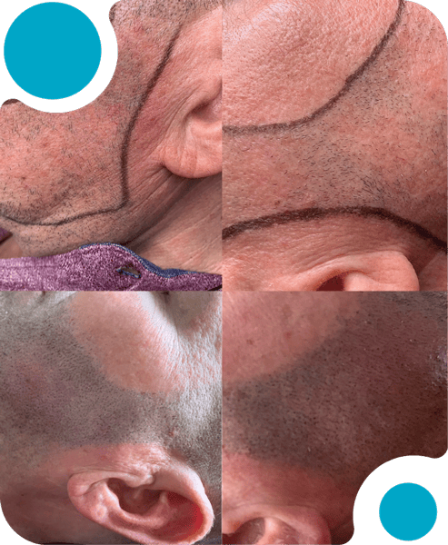 What Is Facial Micropigmentation