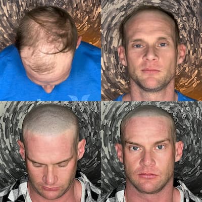 Scalp-Micropigmentation-Services